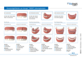 Gesprächshilfe Funktionsprinzip tioLogic® TWINFIT Implantate Patienteninformation (laminiert), deutsch