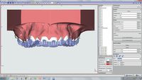 OnyxCeph³™ Modul Bonding Trays 3D