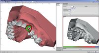 OnyxCeph³™ Modul Bracket Erase 3D