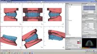 OnyxCeph³™ module Bite Splint 3D
