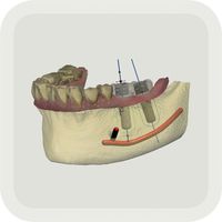TRIOS implant planner app