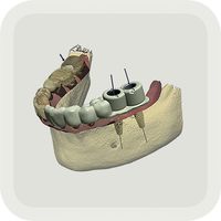 TRIOS Implant Studio app